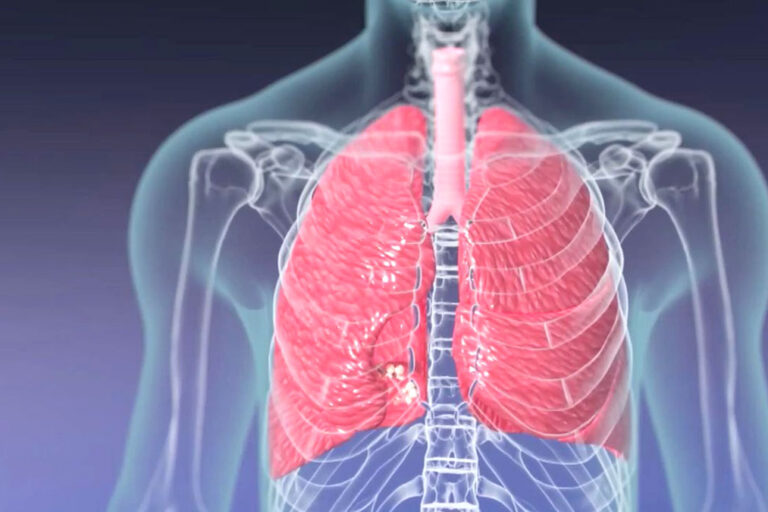 Terapia Bowen pentru tratamentul astmului